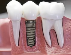 Độ bền của cầu răng sứ được bao lâu ?