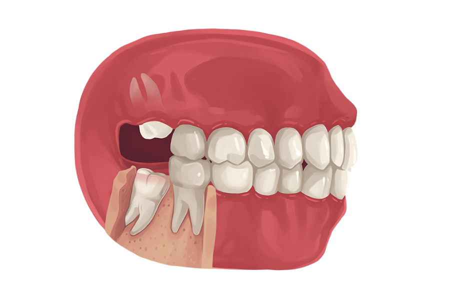 răng khôn hàm dưới