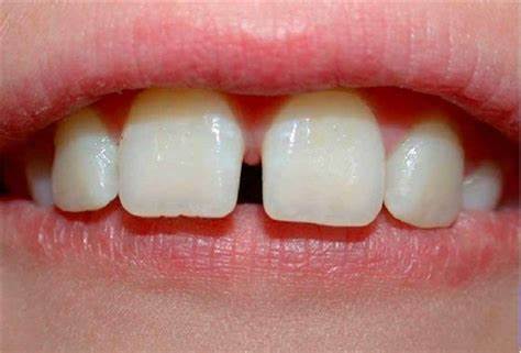 Trám răng chỉ được áp dụng trong trường hợp răng cửa thưa nhẹ, kẽ răng không quá 2mm