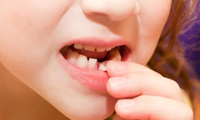Cách chăm sóc răng sữa sau khi nhổ