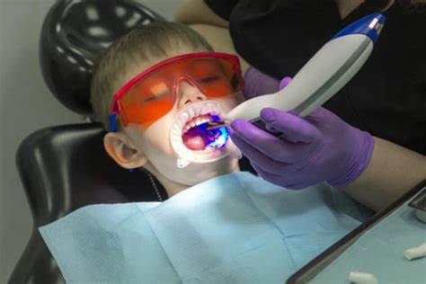 Composite là vật liệu được sử dụng để trám răng cửa thưa vì có màu sắc tương tự như răng thật