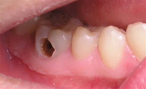Biểu hiện của sâu kẽ răng như thế nào?
