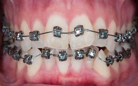 Giá niềng răng cao hay thấp tùy thuộc vào tình trạng răng miệng