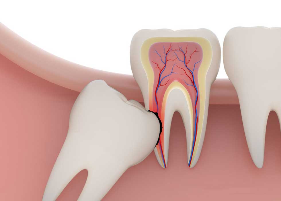 cách phân biệt răng khôn và răng cấm