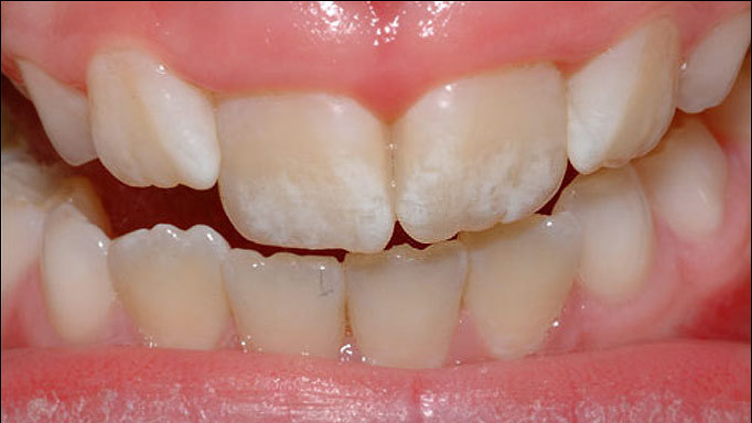 răng nhiễm fluor