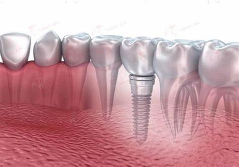 Vậy bảng giá trồng răng Implant bao nhiêu tiền? Cập nhật ngay báo giá chi phí làm răng bằng phương pháp implant mất bao nhiêu 1 cái mới nhất hiện nay để có sự chuẩn bị tốt nhất bạn nhé!
