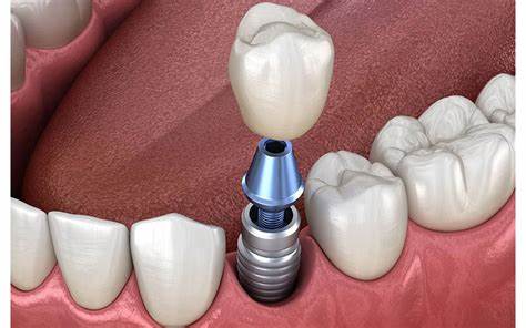trồng răng implant bao nhiêu tiền