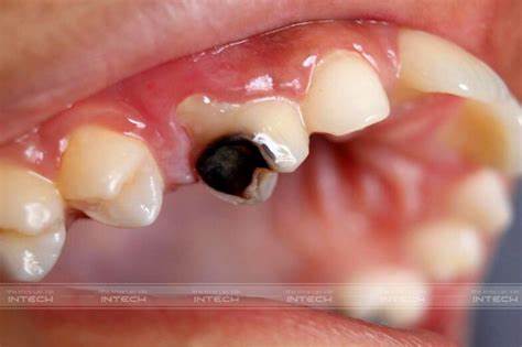 Hình ảnh răng hàm sâu còn lại chân răng