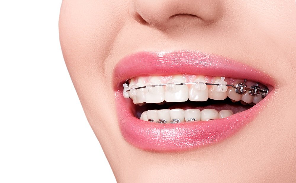 Niềng răng mắc cài sứ tự buộc khác so với niềng răng thường
