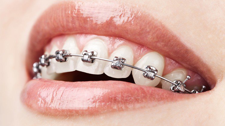 Nên sử dụng phương pháp niềng răng mắc cài tự đóng hay là mắc cài thường?