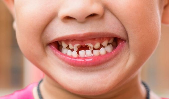 Sún răng hay gặp ở trẻ dưới 1 – 3 tuổi