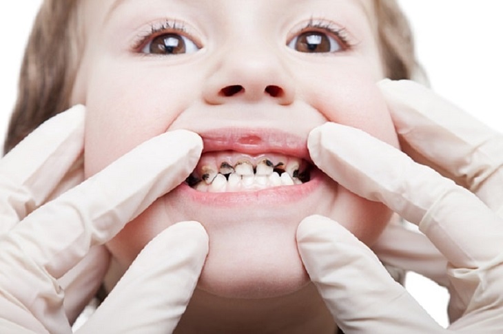 Tình trạng sún răng ở trẻ em nặng có thể khiến răng vĩnh viễn mọc lệch lạc