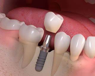 trông răng implant giá bao tiền