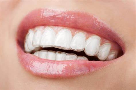 Các loại hàm duy trì sau niềng răng hiệu quả cao nhất hiện nay?
