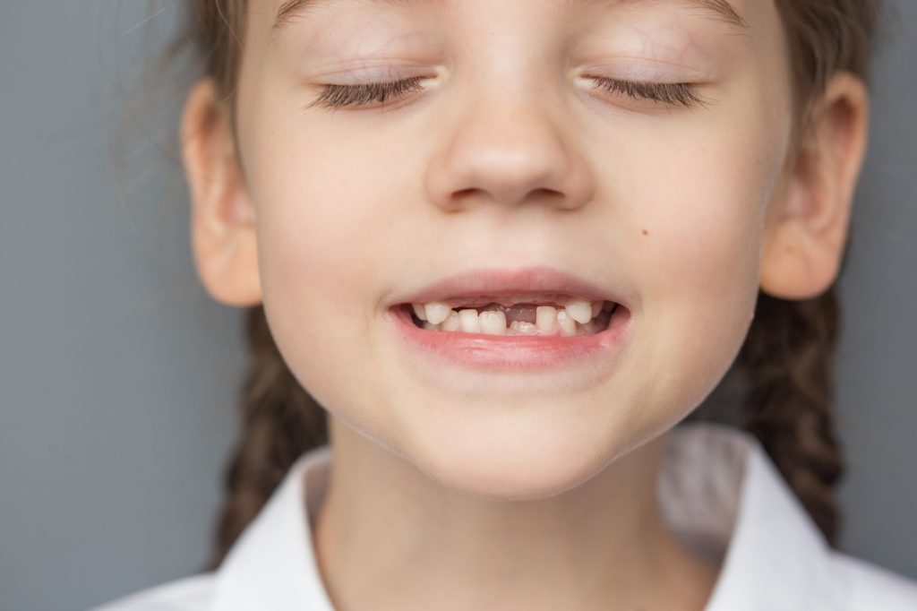 thay răng sữa ở trẻ