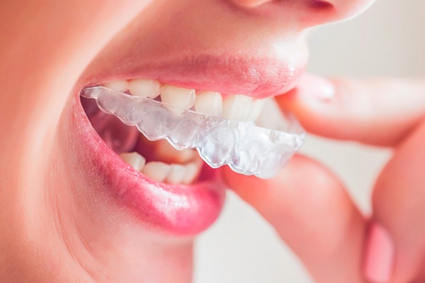 Những trường hợp nào nên niềng răng trong suốt?