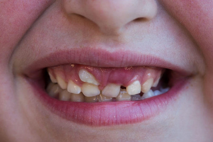 Nguyên nhân răng mọc lẫy thường gặp