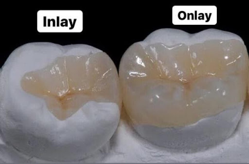Hàn răng sâu lỗ to bằng Inlay – Onlay