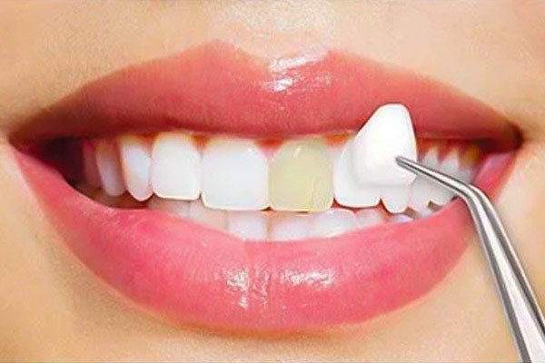 Tác hại của răng sứ thẩm mỹ giá rẻ