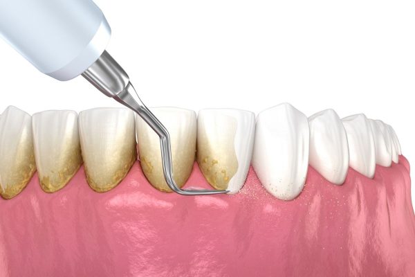 Cao răng gây nên nhiều bệnh răng miệng