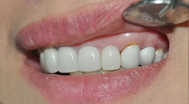 Nguyên nhân khiến răng sứ bị sứt 