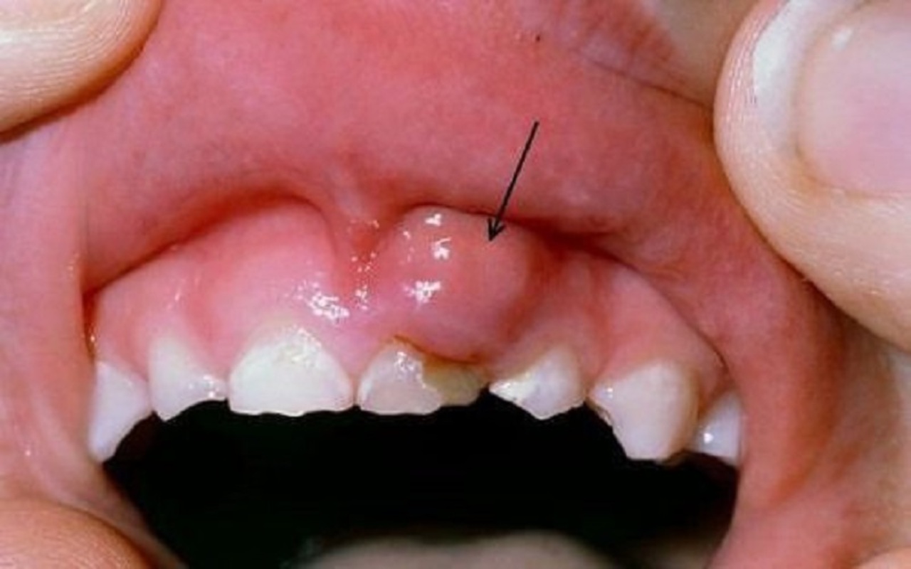nhiễm trùng răng