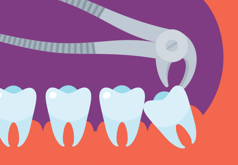 Wisdom Tooth Extraction: When do You Need to Do Wisdom Tooth Extraction?