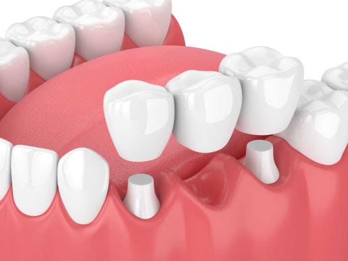cầu răng sứ hay implant