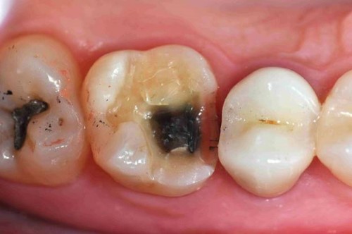 Răng cấm có thay được không?