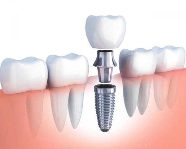 Cầu răng sứ và implant