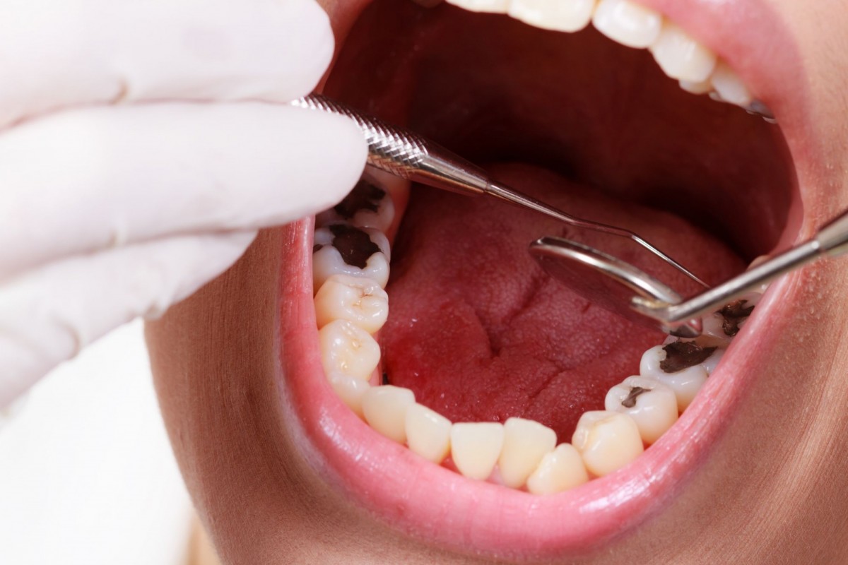 răng hàm sâu bị vỡ chỉ còn lại chân răng