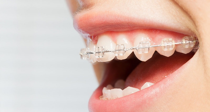 Niềng răng có cần nhổ răng khôn không?