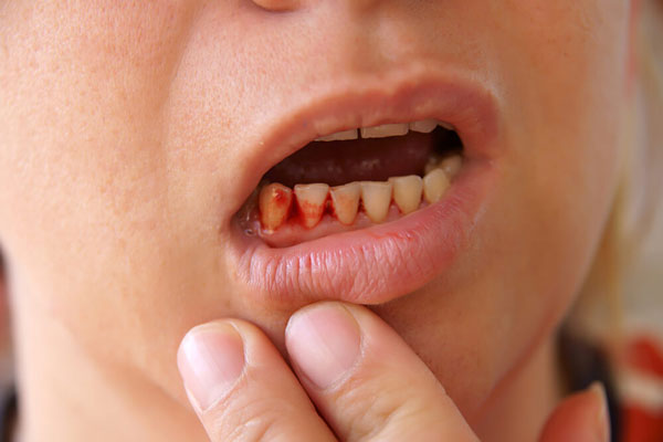 Viêm lợi khiến bạn dễ bị chảy máu khi ăn uống hay đánh răng 