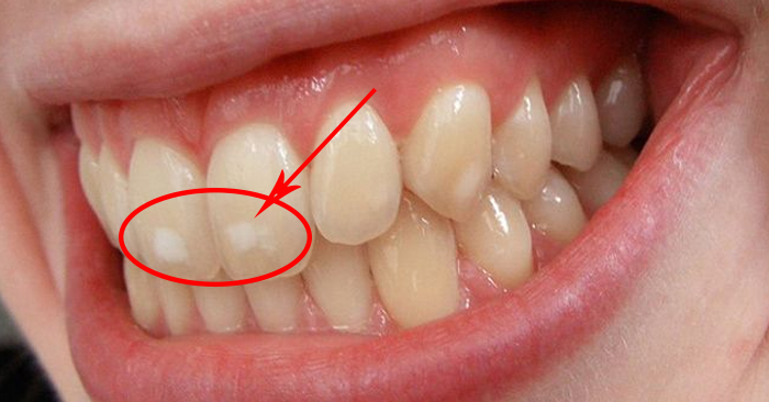  Răng có đốm trắng khi tiếp xúc với florua 