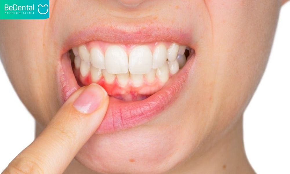 lấy cao răng kiêng ăn gì?