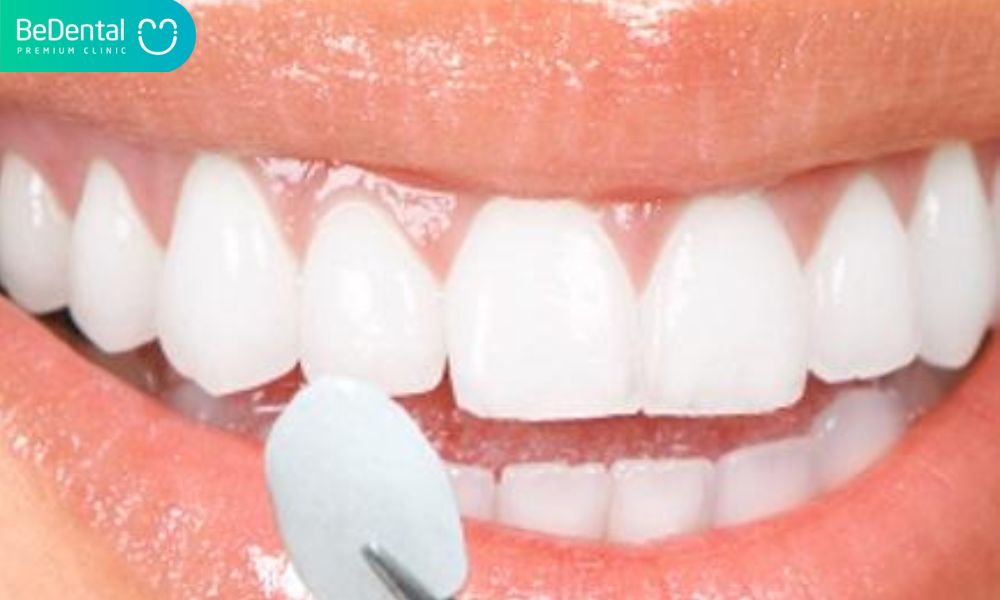 Dán răng veener bao nhiêu tiền?Dán răng veener là gì?Dán răng veneer có tác dụng gì?