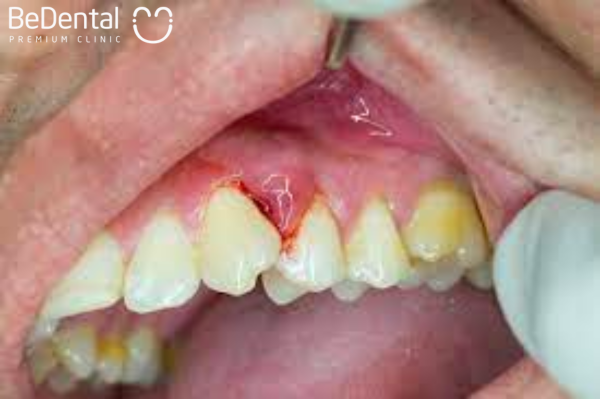 Sưng chân răng hay viêm chân răng là bệnh lý các tổ chức quanh răng bị sưng tấy và viêm nhiễm