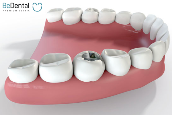 Trám răng với Amalgam chỉ có thể sử dụng trên răng hàm, không dùng cho răng cửa