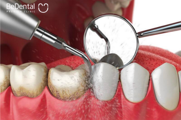 Vôi răng tích tụ lâu ngày ảnh hưởng đến hàm răng