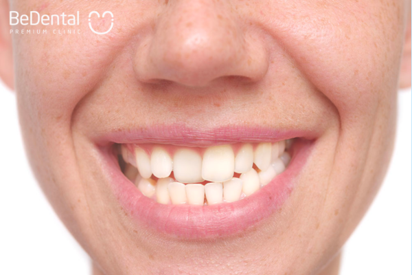 Hình ảnh răng lòi xỉ xấu với răng nanh lệch cao và chen chúc rất nặng.