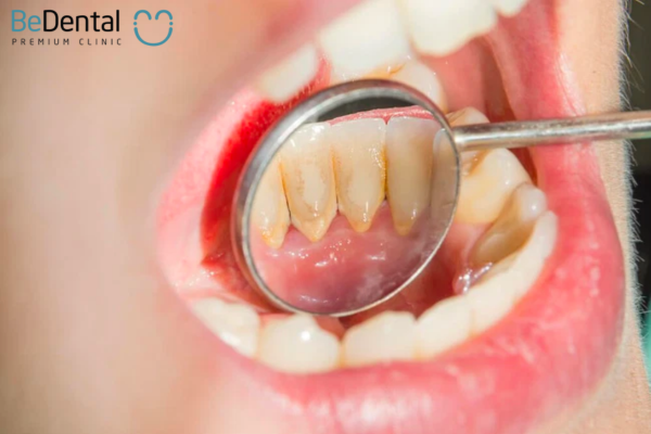 Lấy cao răng giúp bảo vệ khoang miệng và ngăn ngừa nhiều vấn