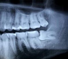 nhổ răng khôn có được bảo hiểm y tế không?