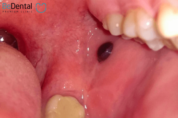 U máu khoang miệng chủ yếu ở trên da hoặc niêm mạc