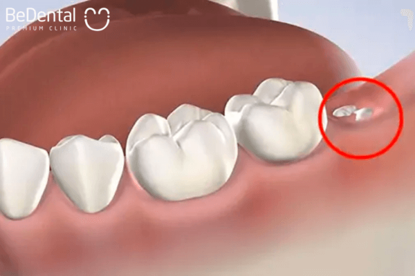 Cấu tạo răng số 8 tương tự với các răng khác nhưng có thời điểm xuất hiện muộn nhất trong số những răng
