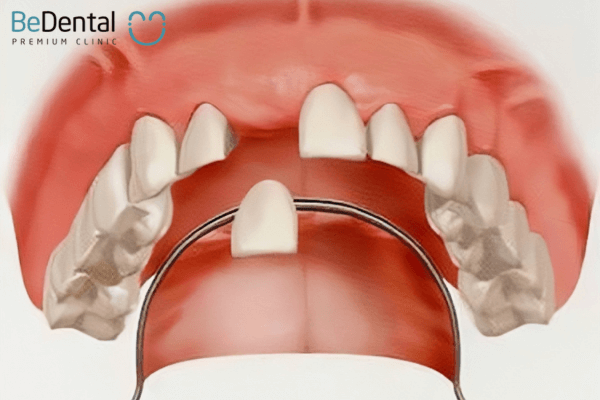 Răng cửa giả tháo lắp là 1 phần hàm có thể tháo lắp được và bên trên là phần răng giả.