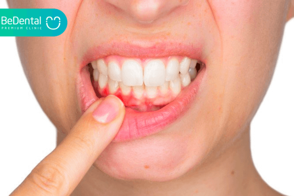 Viêm nướu cũng dễ gây chảy máu chân răng