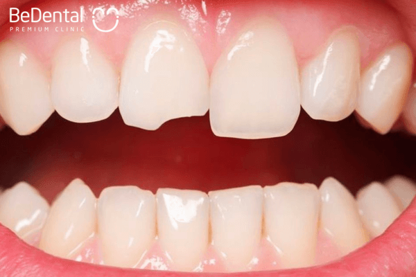 Răng sứt mẻ không thể tự lành