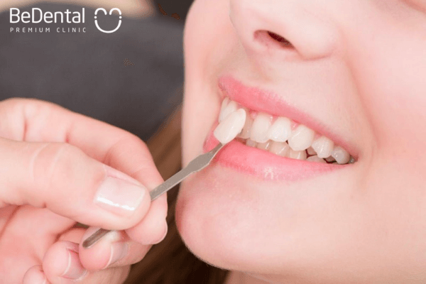 Phương pháp dán sứ cho răng sứt mẻ nhỏ