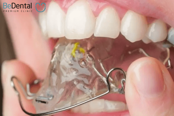 Nong hàm có Mini Implant hỗ trợ