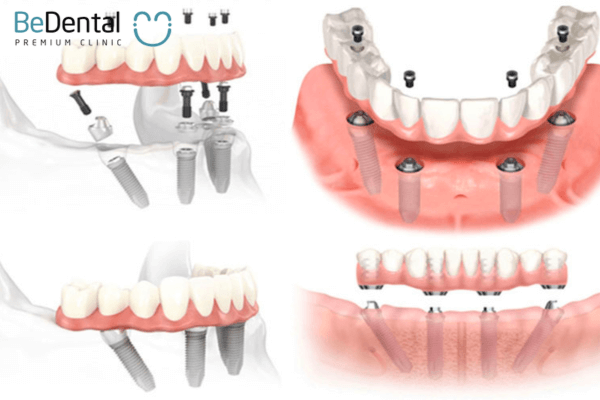 Cấu trúc răng giả tháo lắp trên implant